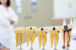 虫歯の進み方と治療法